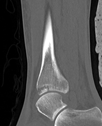 Distal tibia CT